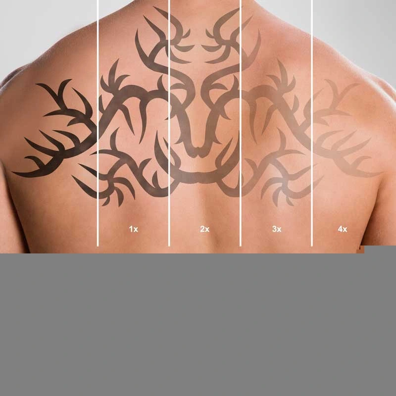 laser tattoo removal 2