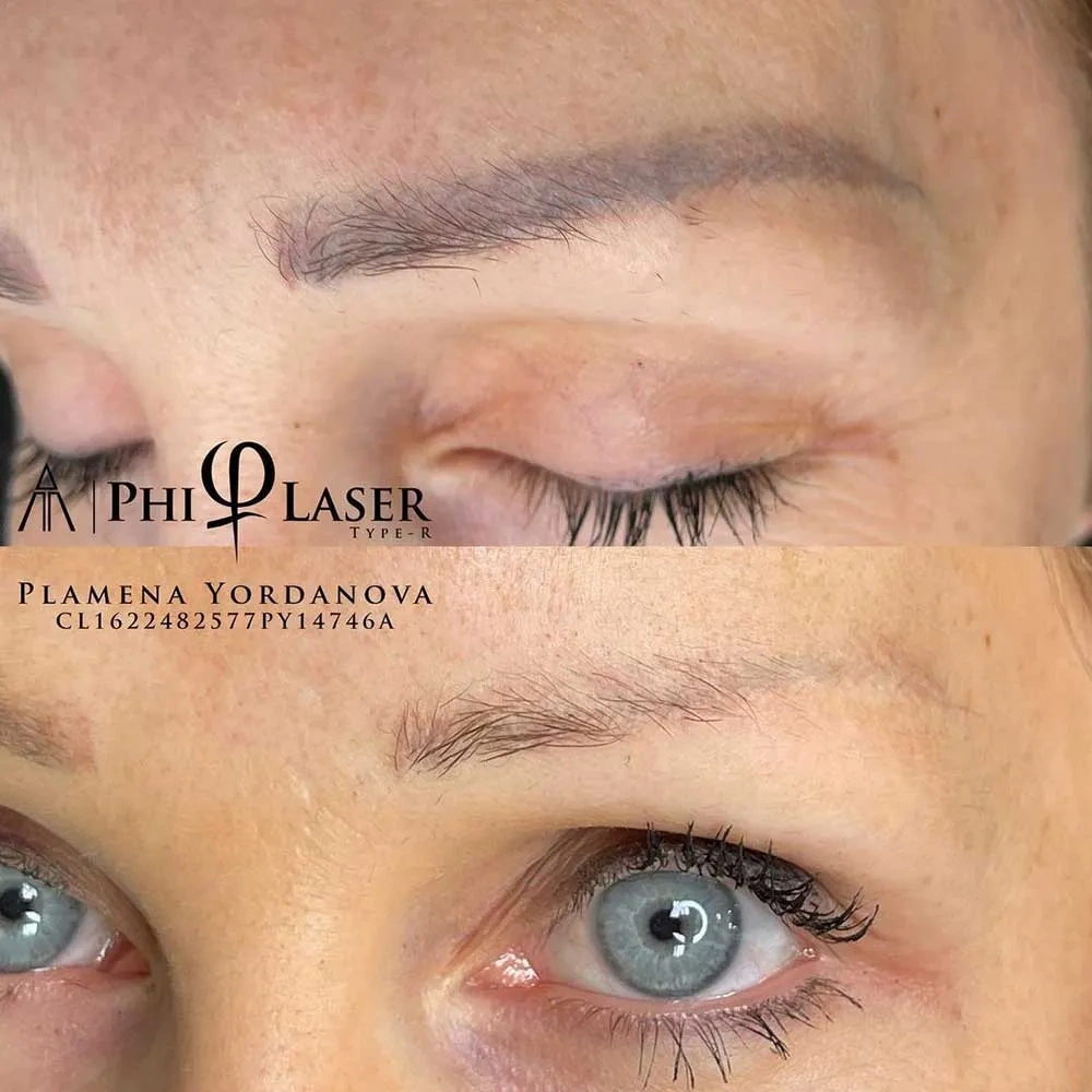 microblading removal before and after