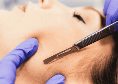 dermaplaning