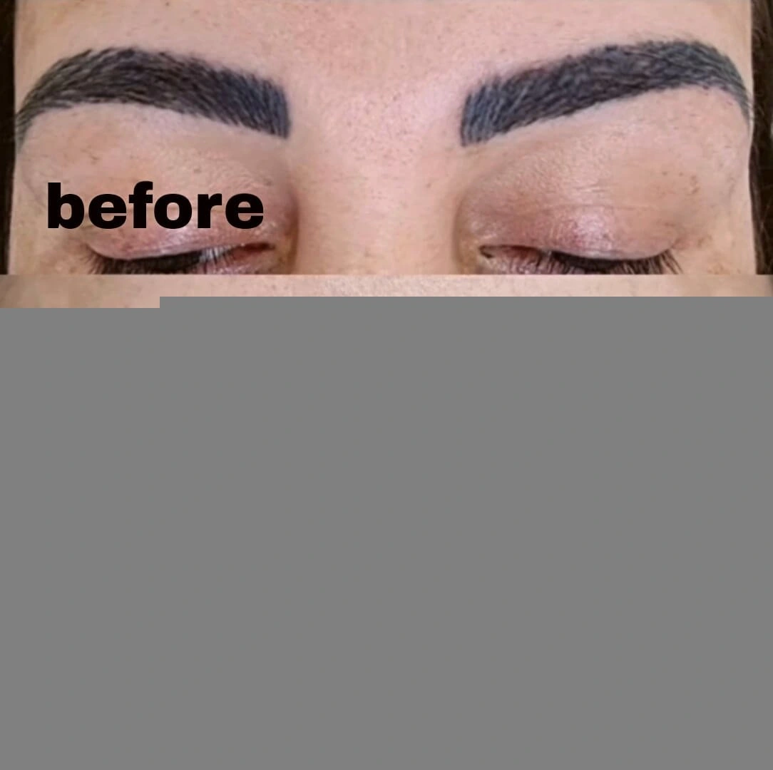 microblading removal cambridge