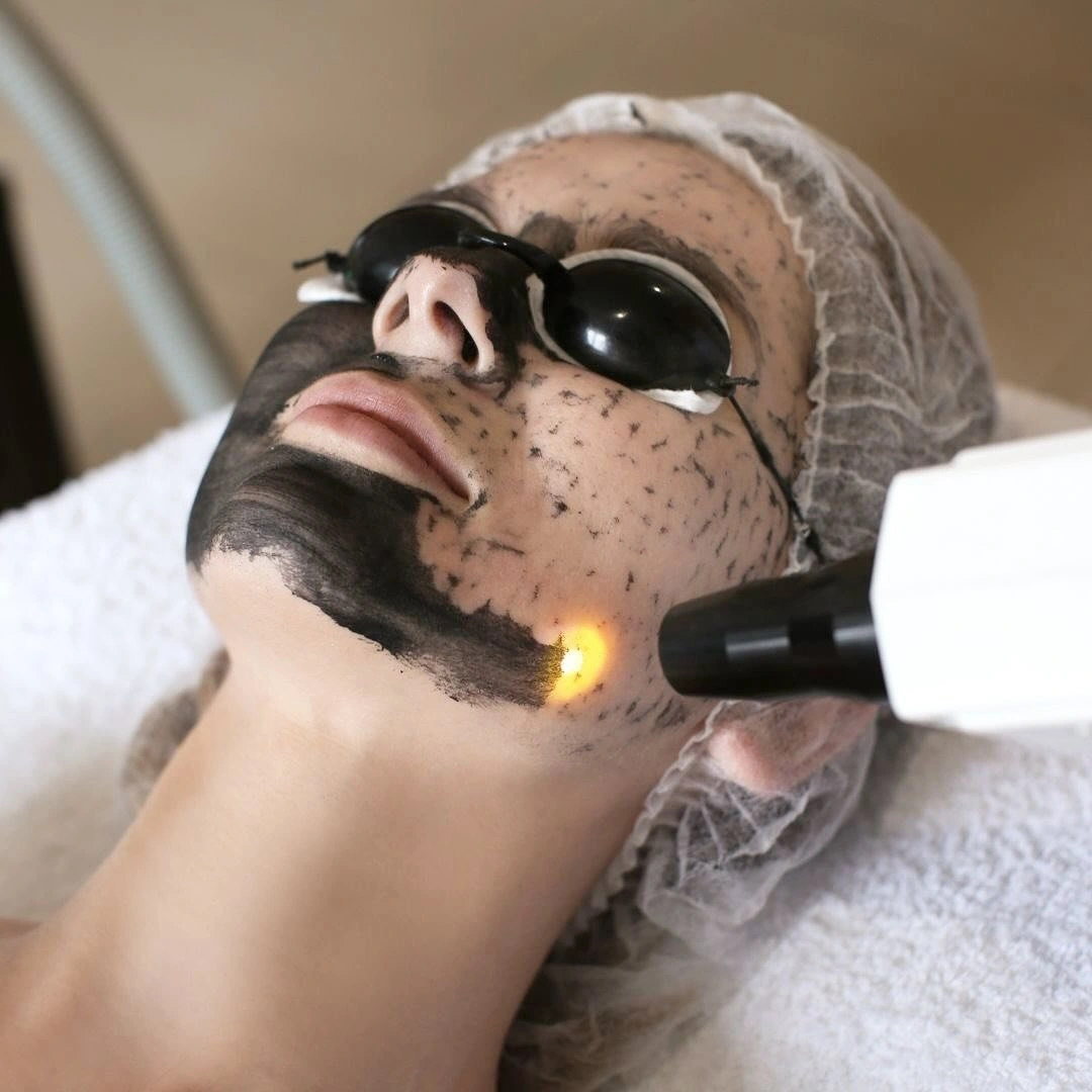 carbonpeeling