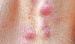 Hidradenitis suppurativa: To niso mozolji in akne
